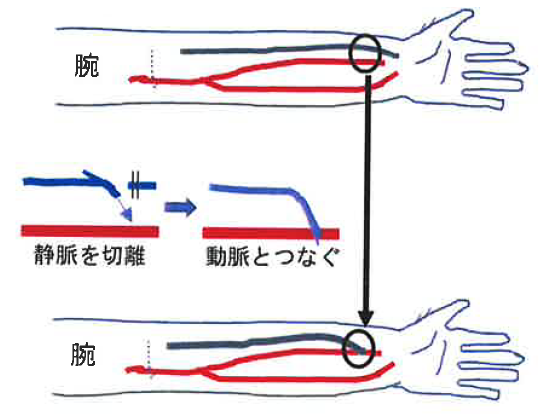 透析シャント手術 シャント手術 Pta 当院の特徴 部門案内 医療法人社団愛友会 蓮田一心会病院 埼玉県蓮田市 伊奈町 上尾市 白岡市