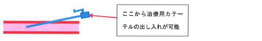 治療の概略①