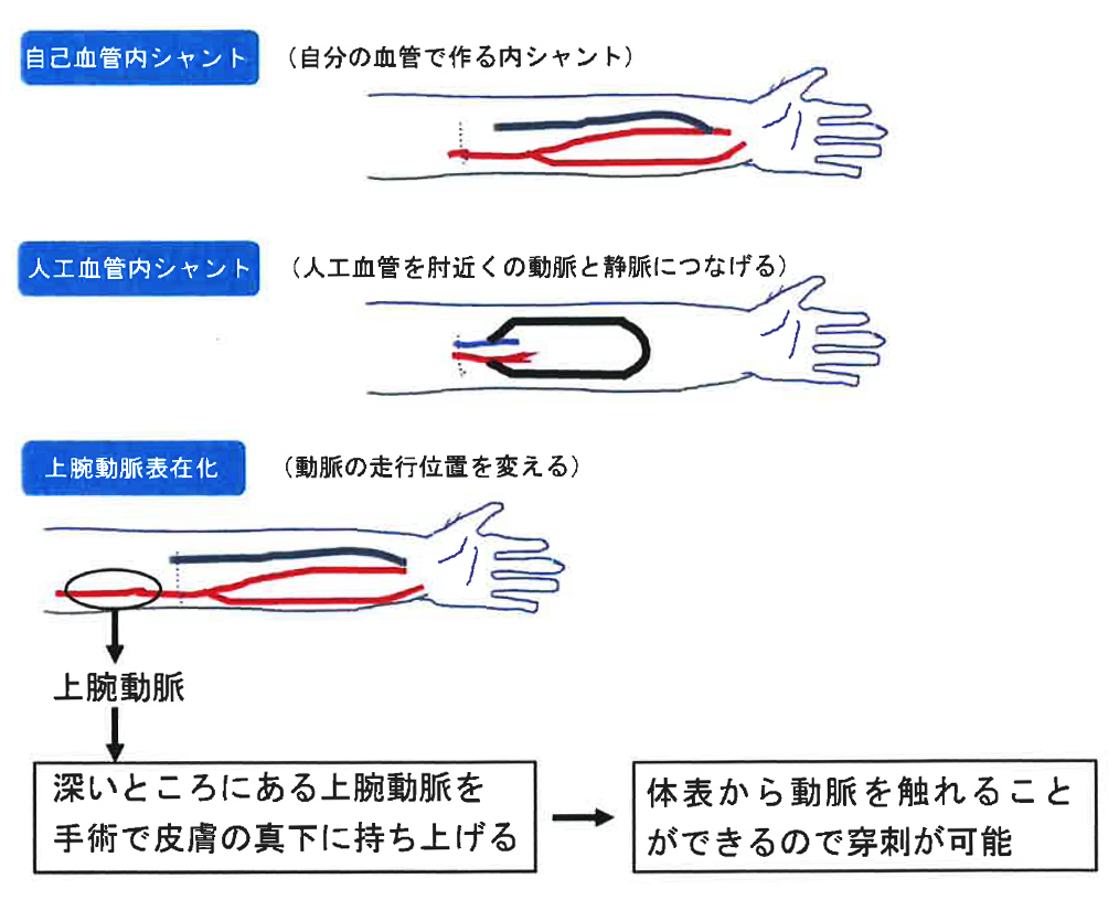 上腕動脈表在化