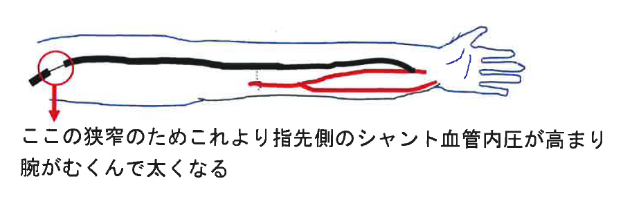 シャント肢静脈高血圧症