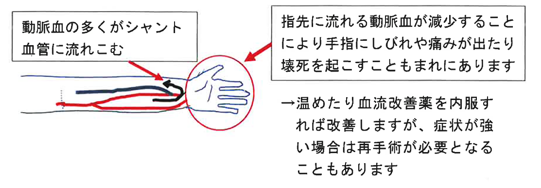 スティール現象